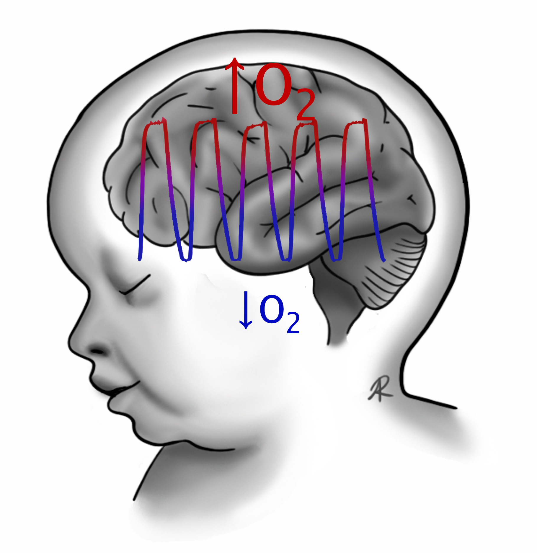 An illustration of a newborn's brain subjected to intermittent hypoxia